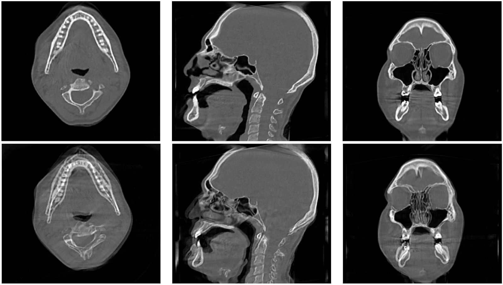 Neuronale CT Rekonstruktion