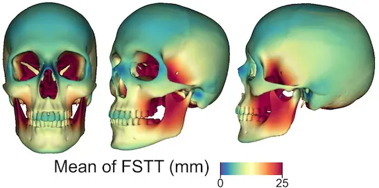 Strahlungsarme 3D-Rekonstruktion des Gesichtsschädels