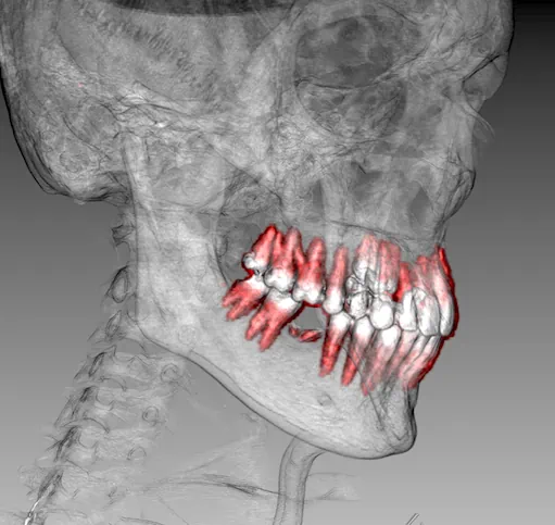 3D Segmentierung von CT Datensätzen